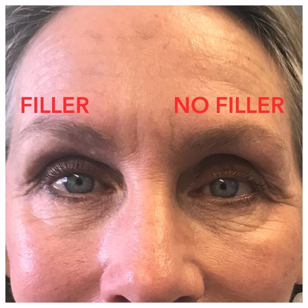 Beverly Hills Sunken Eye Socket Fillers