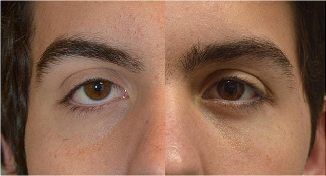 18 year old male, with congenital lower eyelid retraction with negative canthal tilt and droopy upper eyelids (ptosis) underwent almond eye surgery including lower eyelid retraction surgery (with internal alloderm spacer graft), canthoplasty, and upper eyelid ptosis surgery. Before and 3 months after cosmetic eye transforming surgery photos are shown.