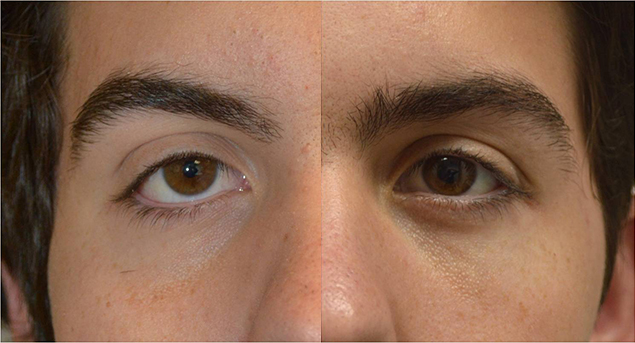 18 year old male, with congenital lower eyelid retraction with negative canthal tilt and droopy upper eyelids (ptosis) underwent almond eye surgery including lower eyelid retraction surgery (with internal alloderm spacer graft), canthoplasty, and upper eyelid ptosis surgery. Before and 3 months after cosmetic eye transforming surgery photos are shown.