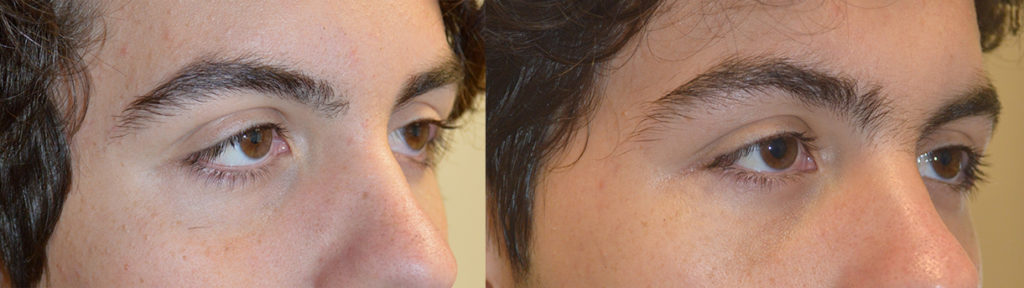 18 year old male, with congenital lower eyelid retraction with negative canthal tilt and droopy upper eyelids (ptosis) underwent almond eye surgery including lower eyelid retraction surgery (with internal alloderm spacer graft), canthoplasty, and upper eyelid ptosis surgery. Before and 3 months after cosmetic eye transforming surgery photos are shown.