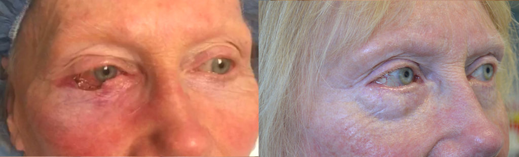 76 year old female, underwent right lower eyelid skin cancer (basal cell carcinoma) Mohs resection and reconstruction of the eyelid. Before and after eyelid surgery photos are shown.
