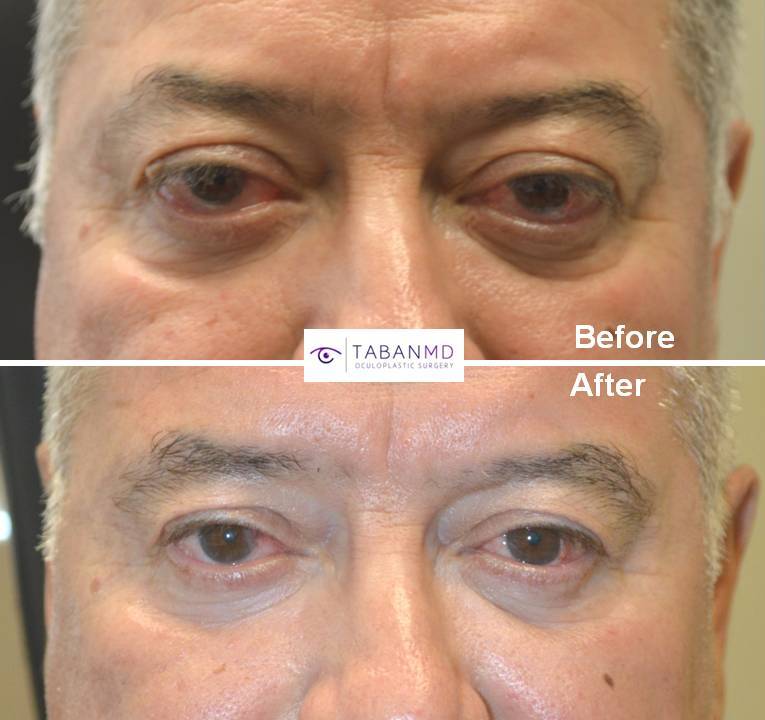 59 year old male, with bulging eyes due to Graves thyroid eye disease, underwent scarless orbital decompression surgery. Before and 3 months after surgery photos are shown.