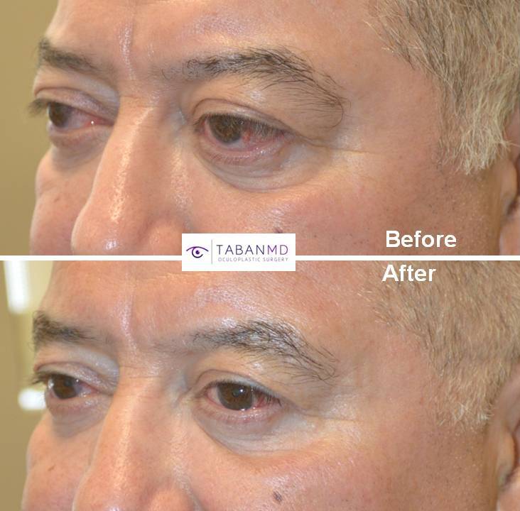 59 year old male, with bulging eyes due to Graves thyroid eye disease, underwent scarless orbital decompression surgery. Before and 3 months after surgery photos are shown.