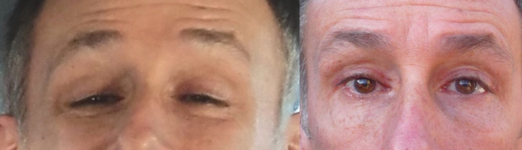 56 year old male with severe genetic upper eyelid ptosis underwent maximal droopy eyelid ptosis repair. Before and 2 months after surgery eyelid surgery selfie photos are shown.