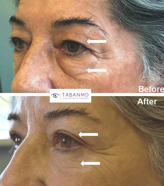 Young Asian female, with inherited bulging eyes, lower eyelid retraction with sclera show, underwent scarless orbital decompression and lower eyelid retraction surgery. She can now close her eyes normally with improved natural eye shape.
