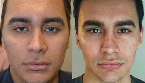 24 year old male, complained of looking sad and tired due to inherited lower eyelid retraction with negative canthal tilt and droopy upper eyelids (ptosis). He underwent almond eye surgery (lower eyelid retraction surgery using scar-less transconjunctival technique and canthoplasty) and upper eyelid ptosis repair. Before and 3 months after eye plastic surgery photos are shown.