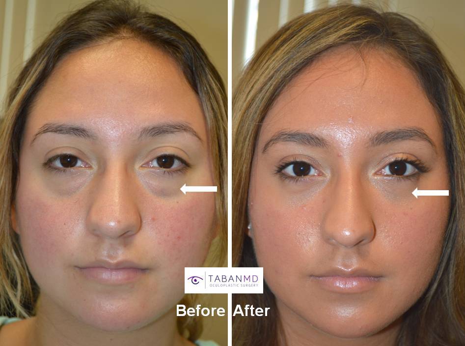 19 year old young woman, with genetic under eye fat bags with dark circles, underwent cosmetic scarless transconjunctival lower blepharoplasty with fat repositioning. Before and 1 month after cosmetic eyelid surgery photos are shown. You can see her full story video of her (before surgery, surgery, postop visits, and full recovery) on our website.