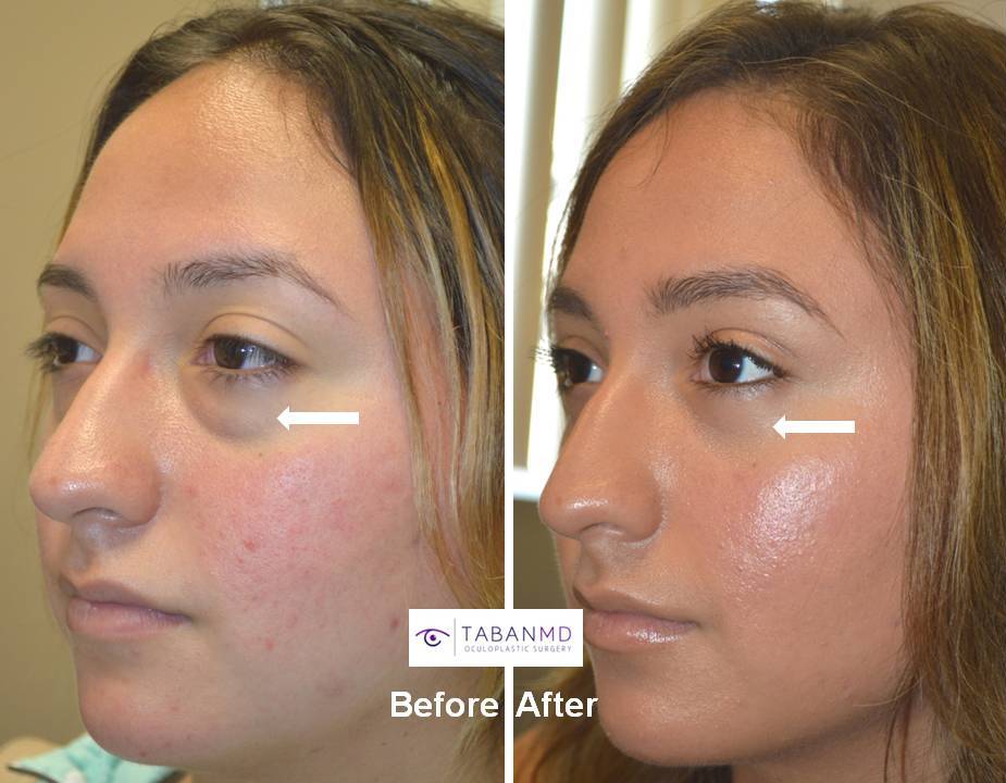 19 year old young woman, with genetic under eye fat bags with dark circles, underwent cosmetic scarless transconjunctival lower blepharoplasty with fat repositioning. Before and 1 month after cosmetic eyelid surgery photos are shown. You can see her full story video of her (before surgery, surgery, postop visits, and full recovery) on our website.