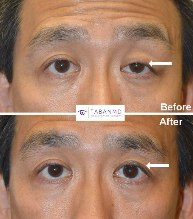 Middle age Asian male, complained uneven eyes with droopy left upper eyelid (ptosis). He underwent scarless left upper eyelid ptosis surgery. Before and 2 months after eyelid procedure photos are shown. Note improved eye symmetry.