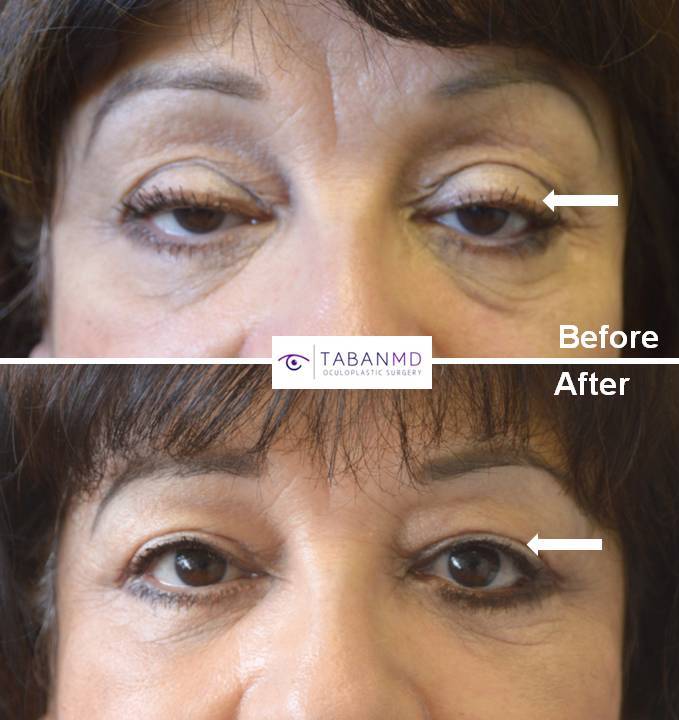 66 year old female with significant age-related droopy upper eyelids (ptosis) underwent droopy upper eyelid ptosis repair and blepharoplasty. Before and 3 months after eyelid surgery photos are shown.