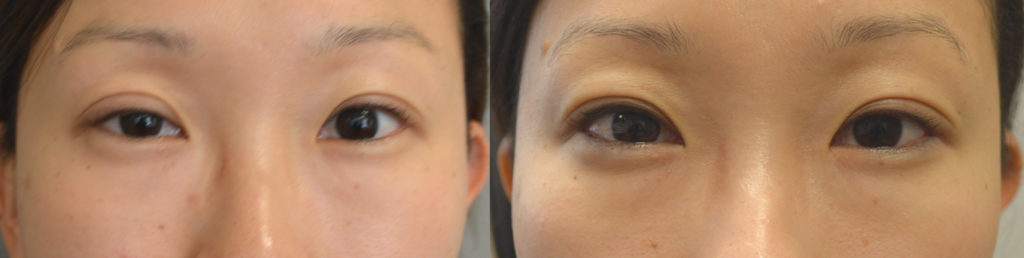 30 year old Asian female, with right upper eyelid ptosis (droopy eyelid) underwent internal (scar-less) right upper eyelid ptosis surgery. Before and 2 months after eyelid ptosis correction photos are shown.