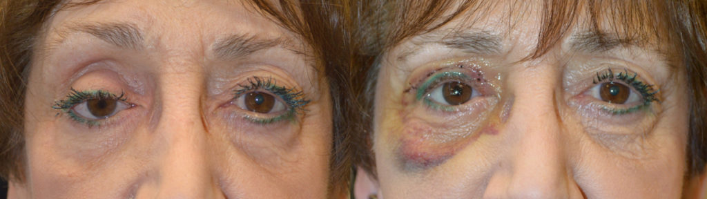 75 year old female, with history of right eye removal with poor eye prosthesis fit and appearance, underwent initial right socket silicone implant placement followed later by right upper eyelid ptosis repair. Before and 1 week after eyelid ptosis repair photos are shown.