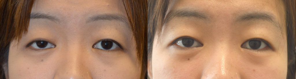 Young Asian female, underwent RIGHT upper eyelid ptosis surgery, using internal scar-less technique.