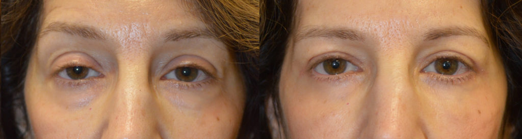 55 year old female, complained of looking tired and older. She underwent cosmetic eyelid procedures including lower blepharoplasty (transconjunctival with fat repositioning) to correct under eye bags, upper blepharoplasty (skin only), and upper eyelid ptosis (droopy eyelid; eyelid lift) surgery. Before and 3 months after photos are shown, with natural results.