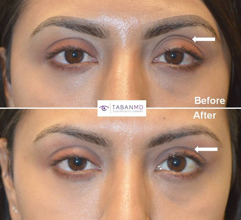 Eyelid filler