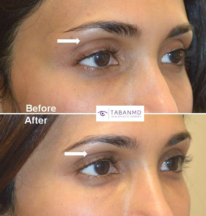 Young woman with deep sunken upper eyelids underwent upper eyelid sulcus filler injection. Note more youthful results.