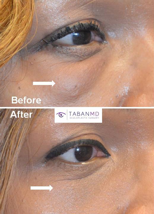 Middle age African American female, with history of eyelid fat injection (by another surgeon) causing significant lumps, underwent scarless technique (from inside the lower eyelid) to remove fat lumps or granulomas. Before and 1 month after revision eyelid surgery photos are shown.