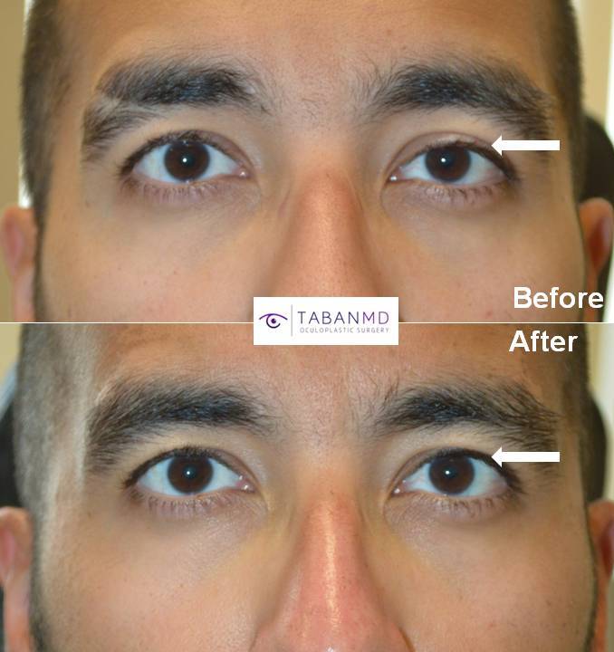 Young man with congenital left upper eyelid ptosis causing eye asymmetry underwent scarless left droopy upper eyelid ptosis surgery under local anesthesia with quick recovery. Note improved eye symmetry in the after photo.