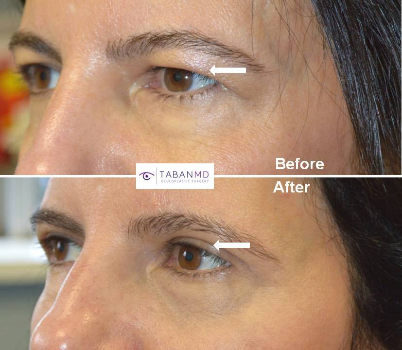 48 year old female with hooded saggy upper eyelids underwent upper blepharoplasty (eyelid lift). Before and 1 month after eyelid surgery photos are shown.