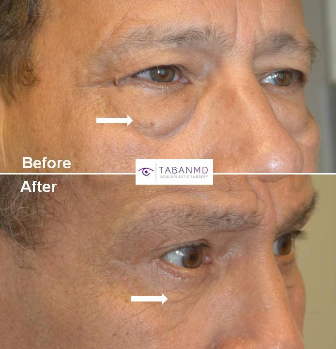 70 year old male, with puffy under eyes due to age-related orbital fat prolapse (under eye fat bags) underwent lower blepharoplasty (transconjunctival with eye fat repositioning and skin pinch), along with upper blepharoplasty. Before and 2 years after cosmetic eyelid surgery photos are shown.