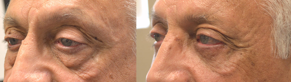 70 year old male, with significant under eye fat bags, hollowness with dark circles, and skin laxity, underwent transconjunctival lower blepharoplasty with eye fat bags repositioning and skin pinch. Before and 2 months after cosmetic eyelid surgery photos are shown. Note the upper eyelids were not operated on. He also has small area of cheek festoons that was not treated.