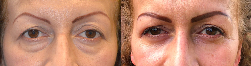 51 year old Hispanic female, complained of looking tired and older due to under eye fat bags with dark circles and loose upper lid skin. She underwent lower blepharoplasty (transconjunctival with fat repositioning, skin pinch) and upper blepharoplasty. Before and 2 months after cosmetic eyelid surgery photos are shown. (The after photo is selfie.)