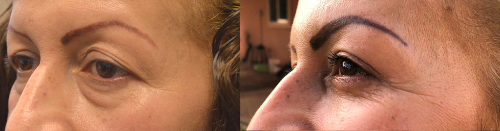 51 year old Hispanic female, complained of looking tired and older due to under eye fat bags with dark circles and loose upper lid skin. She underwent lower blepharoplasty (transconjunctival with fat repositioning, skin pinch) and upper blepharoplasty. Before and 2 months after cosmetic eyelid surgery photos are shown. (The after photo is selfie.)