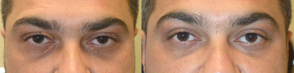 34 year old male, underwent eyelid surgery to remove multiple eyelid xanthalasma (eyelid cholestrol deposits). Before and 2 months after eyelid cholesterol deposits removal photos are shown.