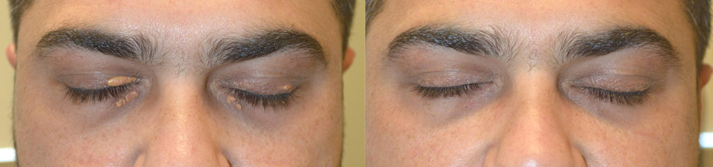 34 year old male, underwent eyelid surgery to remove multiple eyelid xanthalasma (eyelid cholestrol deposits). Before and 2 months after eyelid cholesterol deposits removal photos are shown.