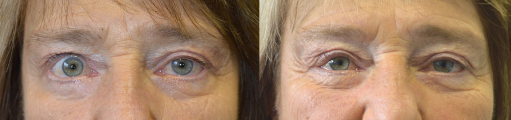 70 year old female, with upper eyelid asymmetry (uneven eyes) due to right upper eyelid retraction, underwent right upper eyelid retraction repair. Before and 3 months after eyelid surgery photos are shown. Note improve eye symmetry.