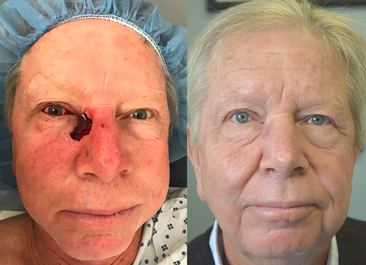 68 year old male, with large right eyelid and nose defect after Mohs surgery to remove basal cell carcinoma, underwent eyelid reconstruction. Before and 6 weeks after eyelid skin cancer reconstruction photos are shown.