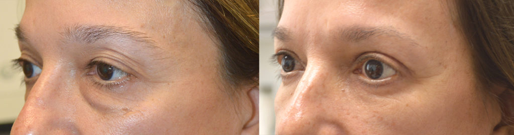 50+ year old female, looking tired and older due to under eye fat bags and dark circles and upper eyelid saggy loose skin, underwent quad-blepharoplasty: upper blepharoplasty (eyelid lift) and lower blepharoplasty (transconjunctival technique with fat bags redistribution and skin pinch). Before and 3 months after eye plastic photos are shown.