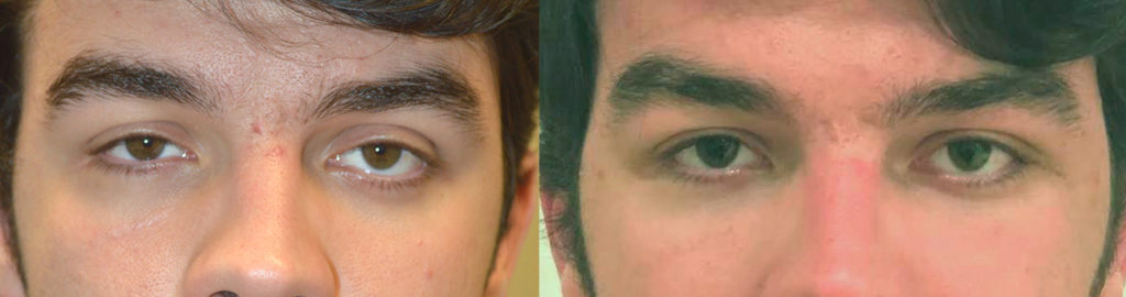 20 year old male, complained of uneven asymmetric eyes. This is due to sunken right eye from orbital blow out fracture and congenital left lower eyelid retraction. He already had right orbital fracture repair by another surgeon with persistent enophthalmos (sunken eye). He underwent left orbital decompression plus left lower eyelid retraction surgery. He also underwent droopy upper eyelid ptosis surgery on both eyes. Before and 6 weeks after eye plastic surgery photos are shown. Note improved eye symmetry and youthful eyes.