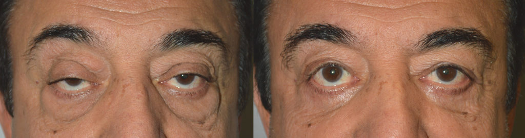 70+ year old male, with significant asymmetric droopy upper eyelids and under eye puffiness (eye fat bags) with skin laxity and dark circles, underwent droopy upper eyelid ptosis correction, upper blepharoplasty (eyelid lift) plus lower blepharoplasty (transconjunctival technique with fat bags repositioning and skin pinch). Before and 3 months after eyelid surgery photos are shown.