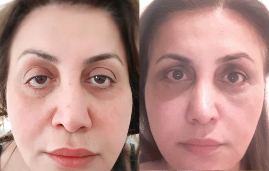 46 year old female from Netherlands, with lower eyelid retraction after botched lower blepharoplasty in Netherlands inherited bulging eyes and droopy upper eyelid (ptosis), underwent corrective revision lower eyelid retraction surgery, orbital decompression surgery for bulging eyes, and droopy upper eyelid ptosis surgery. Before and 3 months after cosmetic eye plastic surgery selfie photos are shown.