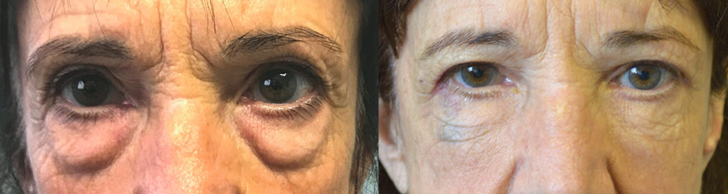 70 year old woman, looking tired and older due to under eye fat bags and dark circles, underwent transconjunctival lower blepharoplasty with fat bags repositioning and skin pinch followed later by cheek filler injection. Before and 3 months after cosmetic eyelid surgery photos are shown.