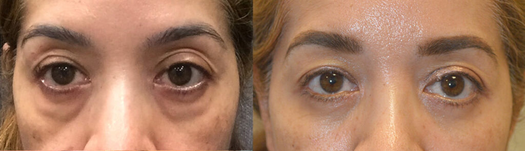 48 year old female, complained of looking tired due to persistent puffy eyes (due to under eye orbital fat prolapse,