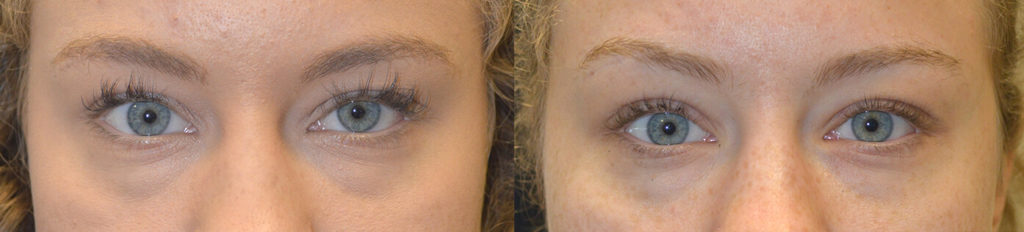 21 year old young woman complained of eye asymmetry with left eye appearing smaller due to congenital droopy left upper eyelid (ptosis). She underwent scarless internal left upper eyelid ptosis repair. Before and 2 months after eyelid ptosis surgery photos are shown. Note improved eye symmetry.