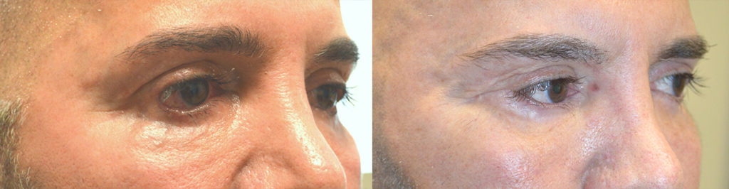 55 year old male, with severe lower eyelid retraction and eyelid scarring due to botched lower blepharoplasty with dry eyes due to inability to close eyes normally, underwent revision eyelid surgery to include lower eyelid retraction (internal approach, soof lift, alloderm spacer graft) with canthoplasty. Before and 3 months after corrective eyelid surgery photos are shown.