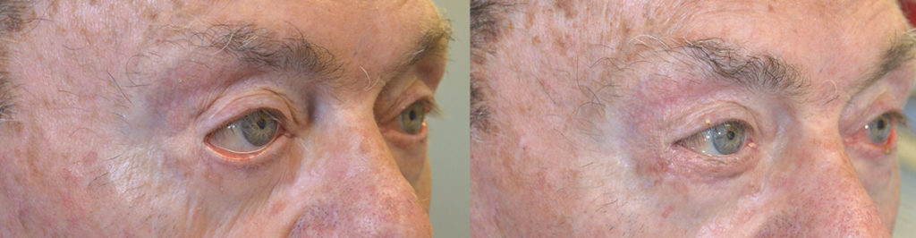 84 year old male, with severe right lower eyelid ectropion due to previous botched lower eyelid surgery and sun damage, underwent right lower eyelid ectropion repair with skin graft. Before and 3 months after reconstructive eye plastic surgery photos are shown.