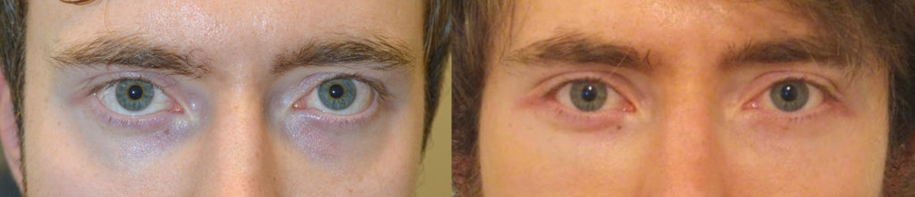 Young man, complained of inherited lower eyelid retraction with sclera show and promiment eyes, underwent cosmetic orbital decompression plus lower eyelid retraction surgery plus orbital rim silicone implant. Before and 3 months after eye plastic surgery photos are shown. Note improved eye appearance in both front and profile views