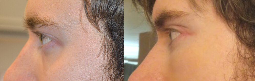 Young man, complained of inherited lower eyelid retraction with sclera show and promiment eyes, underwent cosmetic orbital decompression plus lower eyelid retraction surgery plus orbital rim silicone implant. Before and 3 months after eye plastic surgery photos are shown. Note improved eye appearance in both front and profile views