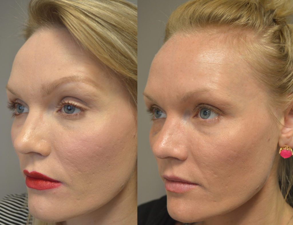 33 year old female, complained of looking tired due to heavy droopy upper eyelids (ptosis) and resultant brow elevation. She underwent bilateral upper eyelid ptosis surgery using internal, scar-less technique, under local anesthesia in the office,with quick recovery. Before and 2 weeks after cosmetic eyelid ptosis surgery photos are shown. Notice the eyes are now more open and eyebrows in more relaxed rested position.