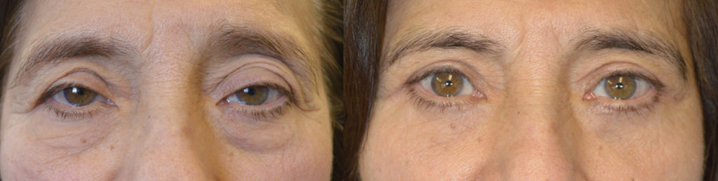 75 year old female, with tired older eye appearance with droopy upper eyelids and eye bags, underwent droopy upper eyelid (ptosis) repair and upper blepharoplasty and lower blepharoplasty (transconjunctival with fat repositioning and skin pinch excision). Before and 3 months after eyelid surgery photos are shown. Note improved rested eye appearance with natural results.