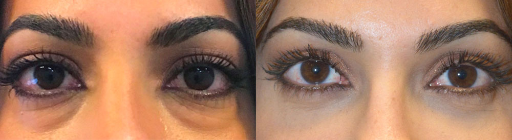 Young woman, bothered by under eye fat bags and dark circles, looking tired, under lower blepharoplasty (transconjunctival with fat repositioning) for more refreshed eye appearance.