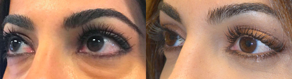 Young woman, bothered by under eye fat bags and dark circles, looking tired, under lower blepharoplasty (transconjunctival with fat repositioning) for more refreshed eye appearance.