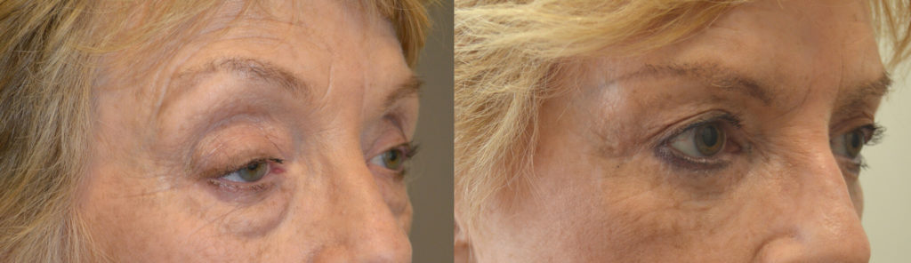 73 year old female, with eyelid aging, underwent droopy upper eyelid ptosis surgery, upper blepharoplasty, lower blepharoplasty (transconjunctival with fat repositioning and skin pinch) and lateral pretrichial brow lift, under conscious sedation. Before and 3 months after eyelid surgery photos are shown.