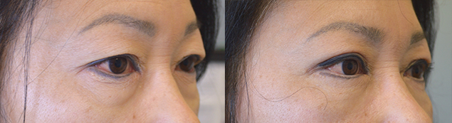 Middle age Asian female, underwent Asian upper blepharoplasty with crease formation. Before and 2 months after Asian blepharoplasty photos are shown.