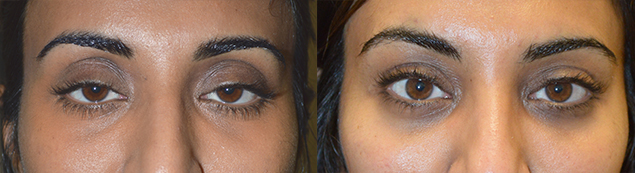 35 year old Indian female, complained of looking tired and older. She underwent scarless internal droopy upper eyelid ptosis surgery and upper eyelid fat injection. Before and 1+ year postoperative photos are shown.