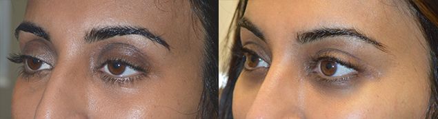 35 year old Indian female, complained of looking tired and older. She underwent scarless internal droopy upper eyelid ptosis surgery and upper eyelid fat injection. Before and 1+ year postoperative photos are shown.